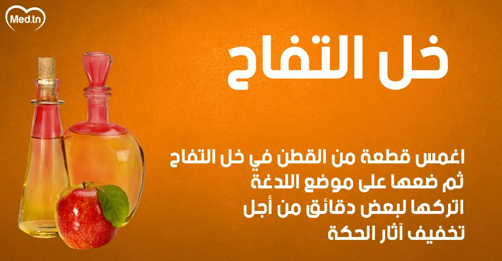 6 طرق طبيعية لعلاج قرصة الناموس